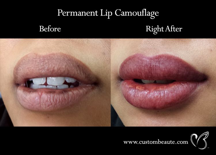 Permanent Lip Camouflage - Microblading