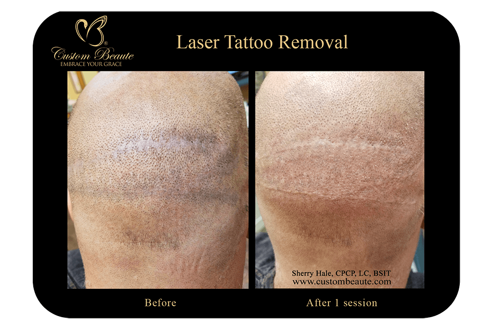 Before and after Laser Tattoo Removal